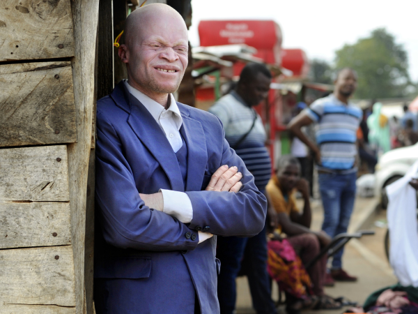 Malawi 2022 People With Albinism Baison Makolopa banner image