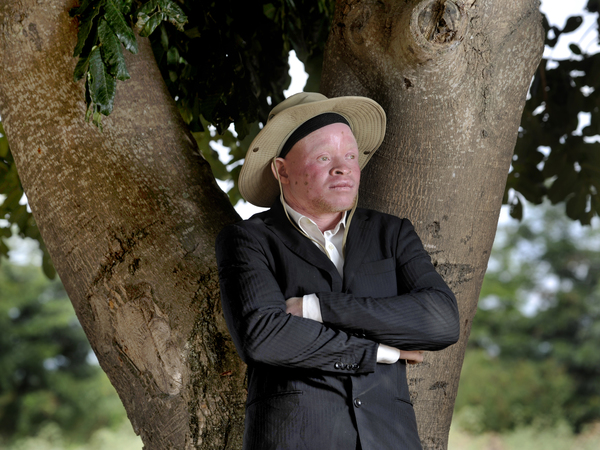 Malawi albinism project 3