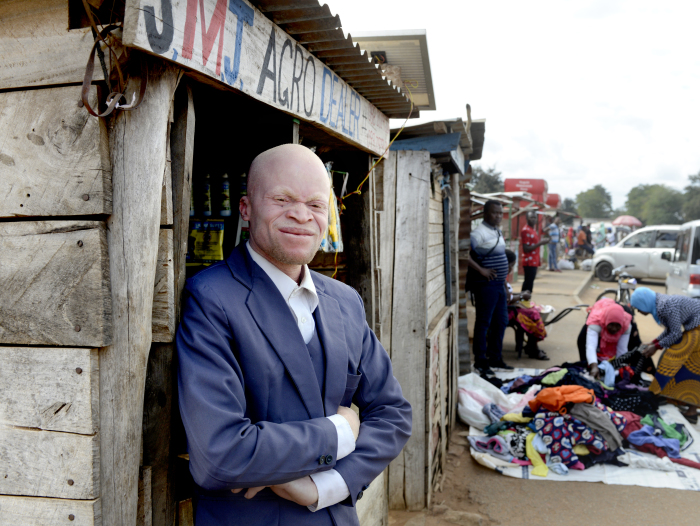 Malawi 2022 People With Albinism Baison Makolopa 07