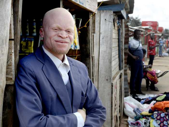 Malawi 2022 People With Albinism Baison Makolopa 07