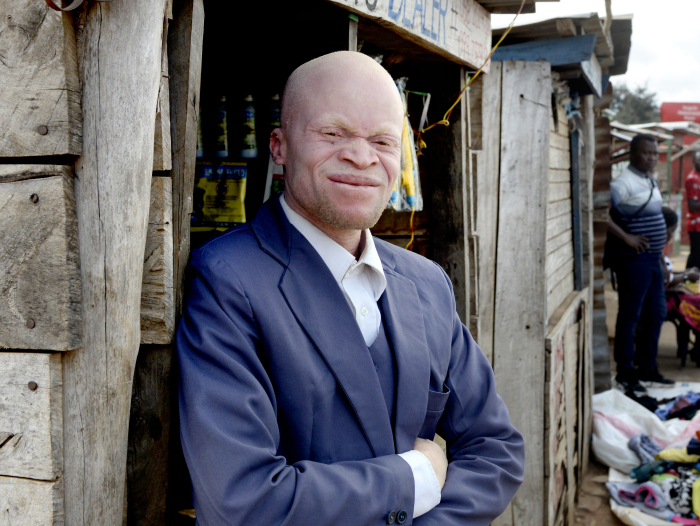 Malawi 2022 People With Albinism Baison Makolopa 07