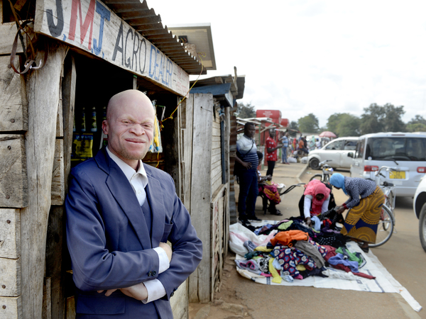 Malawi 2022 People With Albinism Baison Makolopa 07
